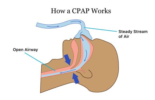 如何調整 CPAP